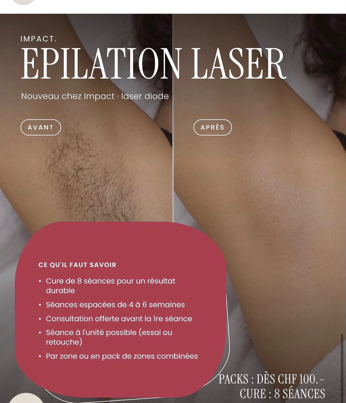 Avant et après une cure d’épilation laser diode sur les aisselles